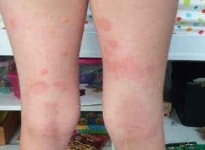 Childhood Eczema Tips and Tricks - My Allergy Kitchen